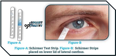 tear function test|positive schirmer's test.